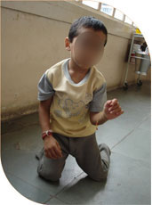 four year old boy who was not able to stand due to spasticity in his calf muscle and hamstrings (muscles at the back of the knee), was given botulinum injections in both muscles in both legs