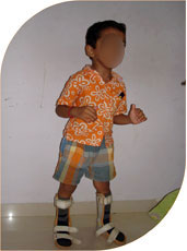 He started stadnign with help of splints and could walk after regular physiotherapy after four months of injection. Though the effect of botulinum toxin lasts for few months the beneficial effects can last for years provided the child is regular in physiotherapy and is wearing prescribed splints regularly