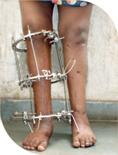 After three months of right leg surgery she was operated on the other side.
