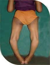 Chandani, a chirpy 12 year old girl with gross bowing of legs. She could not walk long and could not play with her friends.