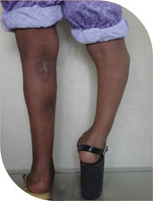She then underwent surgery on her right leg with Ilizarov technique. During this surgery her deformity was completely corrected and she gained extra length of10 cm.