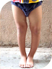 bow legs due to Rickets (vit D deficiency)