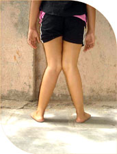 Sulagna seven year old girl came to us with knock knees, on detailed investigation no particular cause could be found. 
