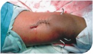 At COC a novel technique of deformity correction is carried out which results in complete correction of deformity with very small, nearly invisible scar.