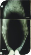 A special x ray done for her legs showed that she had problem in her hip region and the leg bones were curving inside at two levels.