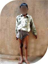 he had complete eradication of infection and he started standing and walking independently