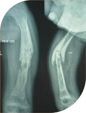 Post infection nonunion of femur (thigh bone)