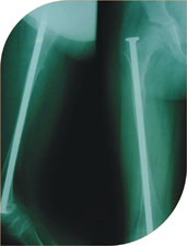 She was treated with telescoping nails and she has complete correction of deformity and is fracture free for last four years. She is on oral bisphosphonates.
