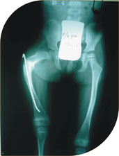 She was treated with telescoping nails and she has complete correction of deformity and is fracture free for last four years. She is on oral bisphosphonates.