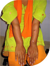 After cutting her radius bone in the lower end a special ring with its special attachments was fitted around wrist region and then the bone was moved with the machine in three dimensions correcting all the aspect of the deformity.