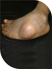Neglected cases