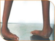 Club Foot Symptoms