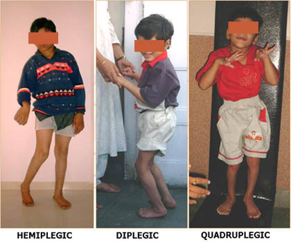 Spastic Cerebral Palsy