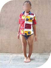 bow legs due to Rickets (vit D deficiency)
