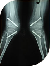 She underwent screw hemi epiphysiodesis correcting deformity in two years.