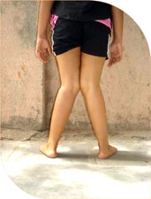 Sulagna seven year old girl came to us with knock knees, on detailed investigation no particular cause could be found.