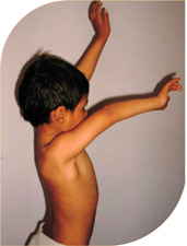 Shoulder problem with bony deformity