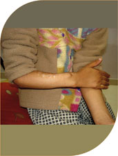 Finally he had complete cure in form of shape, function of his wrist and the length was also reestablished.