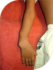 Nonunion of forearm bone following bone infection