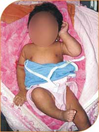 Obstretical Brachial Plexus Palsy Diagnosis