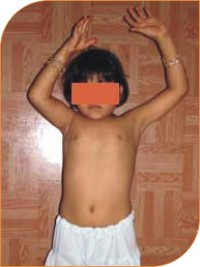 Obstretical Brachial Plexus Palsy treatment