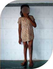 She successfully underwent surgery by conventional method and her deformity was completely corrected and she resumed her life without any handicap.