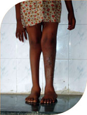 She successfully underwent surgery by conventional method and her deformity was completely corrected and she resumed her life without any handicap.