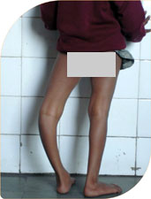 Five year old Komal with bowing of one leg