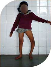 Five year old Komal with bowing of one leg